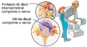 lombalgia ocupacional