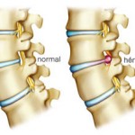 doenca-hernia-de-disco-lombar